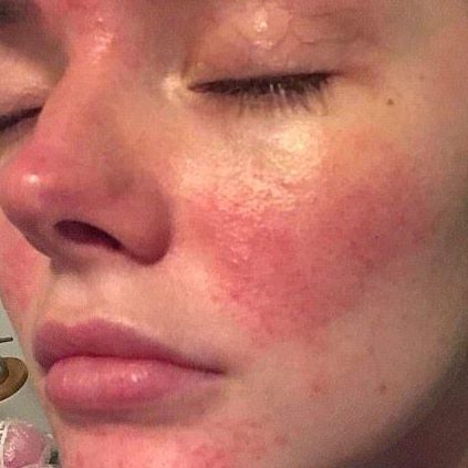 Beautician battling rosacea reveals the products that banish redness edited