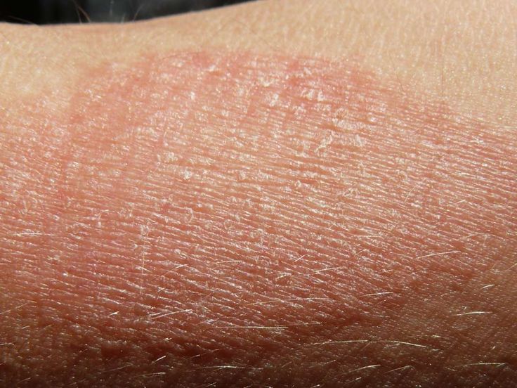 Dry skin patches Causes symptoms diagnosis and treatments